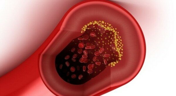 Норма холестерина в крови у женщин и мужчин по возрасту. Таблица