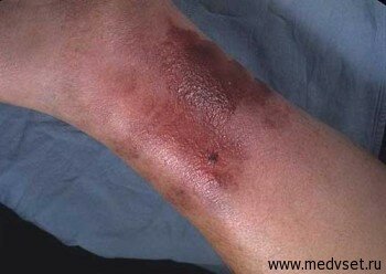 Рожистое воспаление ноги. Симптомы и лечение
