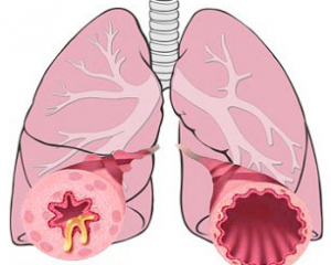 Бронхиальная астма. 