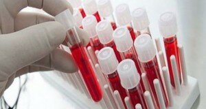 Онкомаркеры СА 125: расшифровка анализа крови, норма