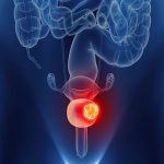 Рак мочевого пузыря: симптомы, диагностика и методы лечения